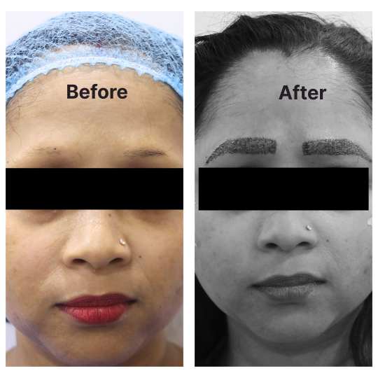 Hair Transplant result KOQ10